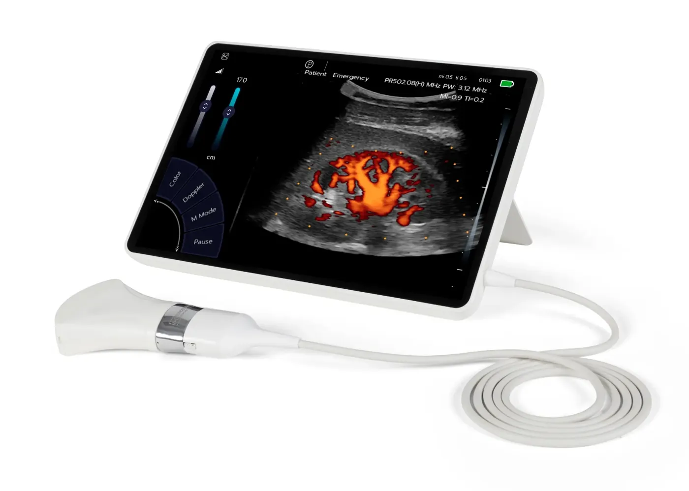 T-Lite Pro — доплерівське сканування нирки конвексним датчиком